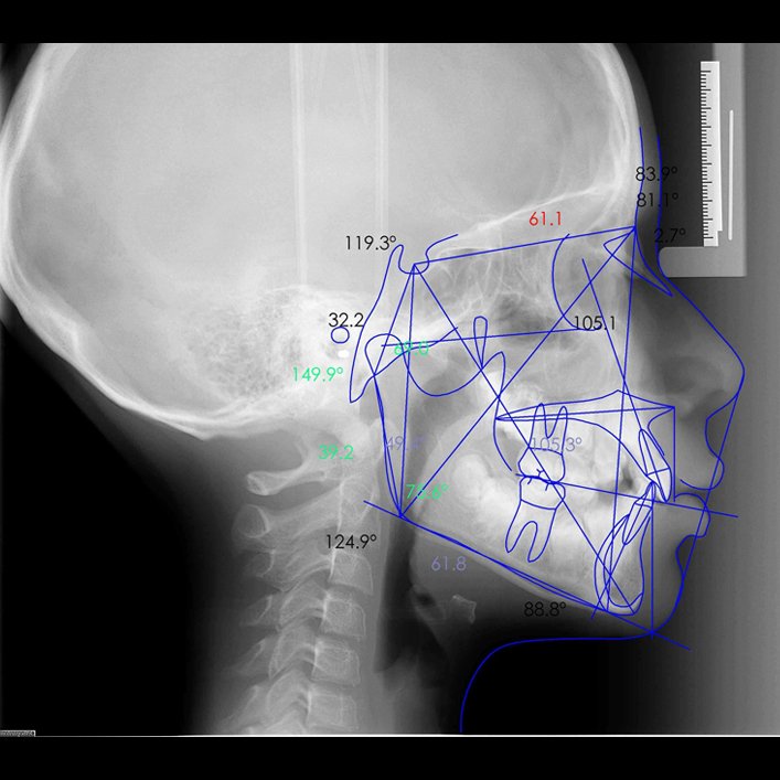 Trazado cefalométrico